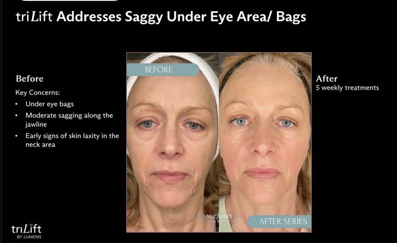 LIVE AUCTION - Holiday Radiance by Bliss