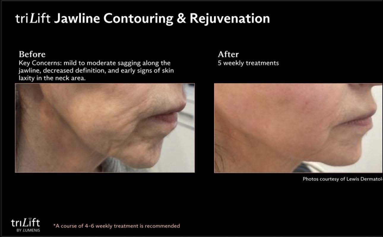 LIVE AUCTION - Holiday Radiance by Bliss