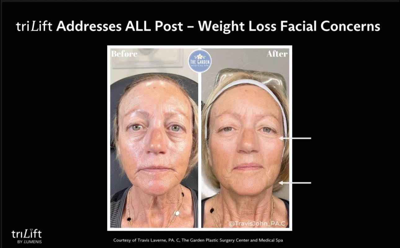 LIVE AUCTION - Holiday Radiance by Bliss